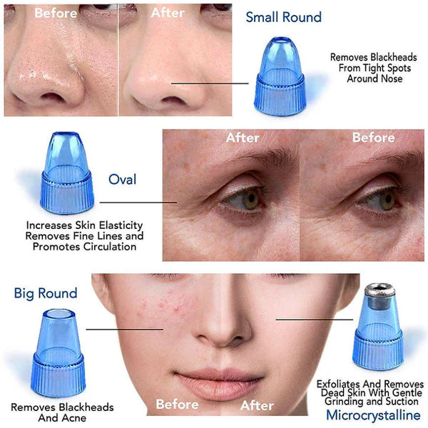 4-in-1 Vacuum Derma Suction Pore Cleaner – Blackhead Remover & Facial Skin Care Device